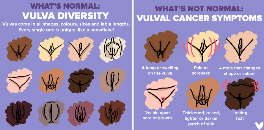 What is normal - vulva diversity. Vulvas come in all shapes, colours, sizes and labia lengths. Every single one is unique, like a snowflake! What's not normal - vulval cancer symptoms. A lump or swelling on the vulva, pain or soreness, a mole that changes shape or colour, visible open sore or growth, thickened, raised, lighter or darker patch of skin, lasting itch.